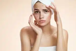 How to Prevent Pimples Naturally at Home