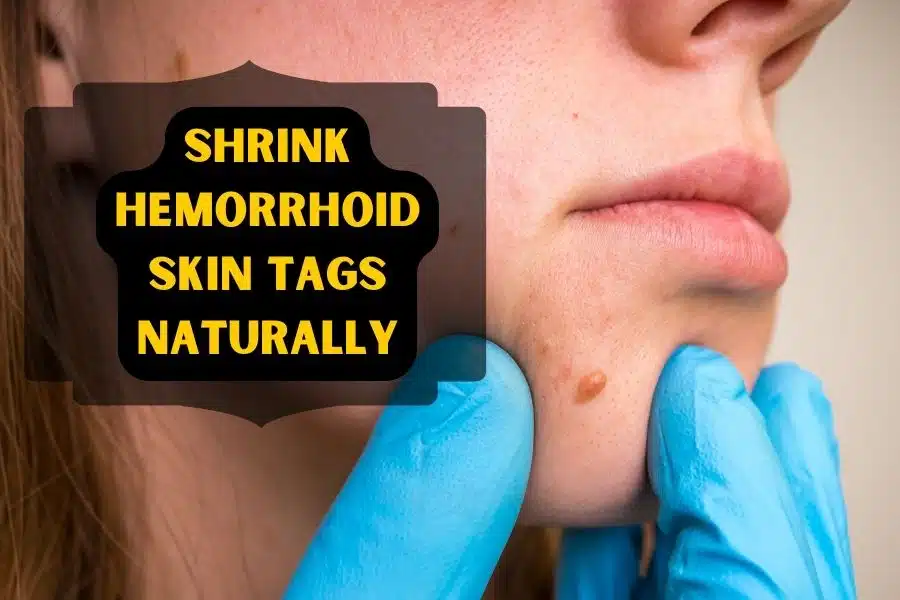 Shrink Hemorrhoid Skin Tags Naturally at Home
