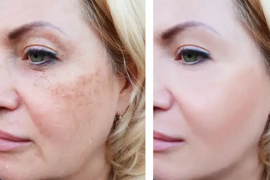 How to Remove Face Pigmentation