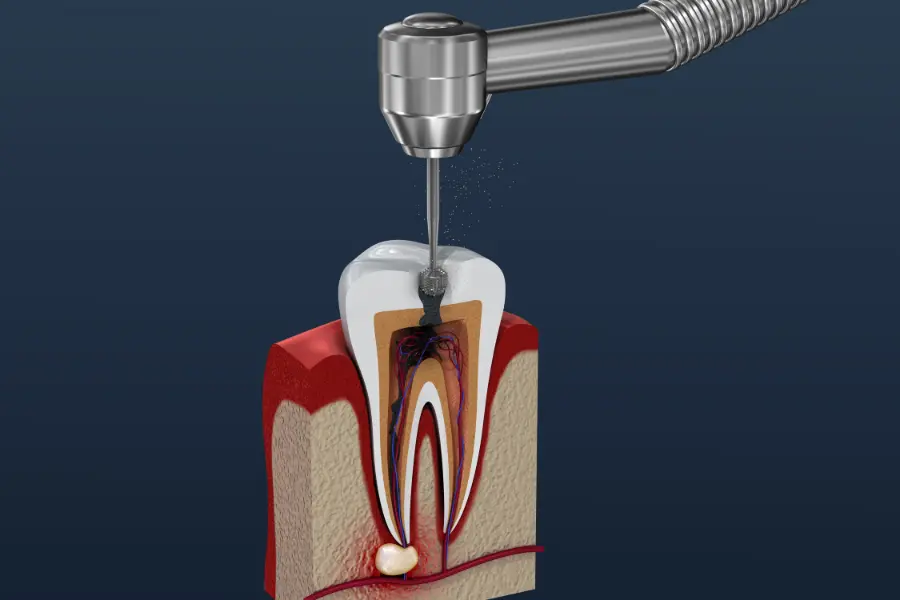 Why Re Root Canal Is A Must for Many Patients