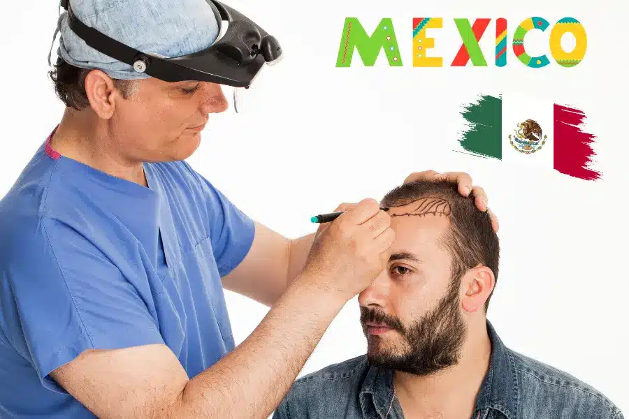 Three of the Best Hair Transplant Clinics in Mexico
