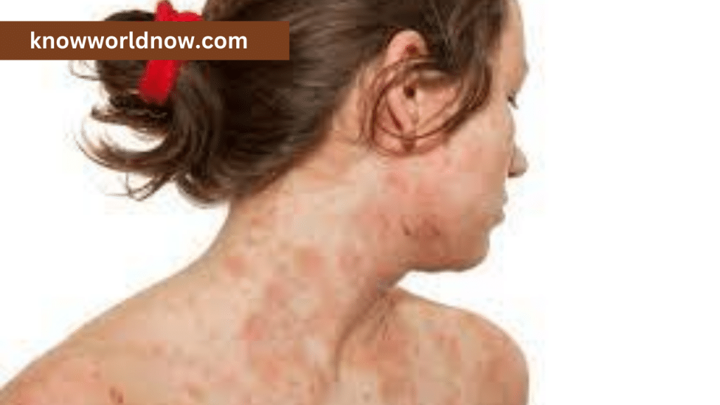 Treatment of Eczema