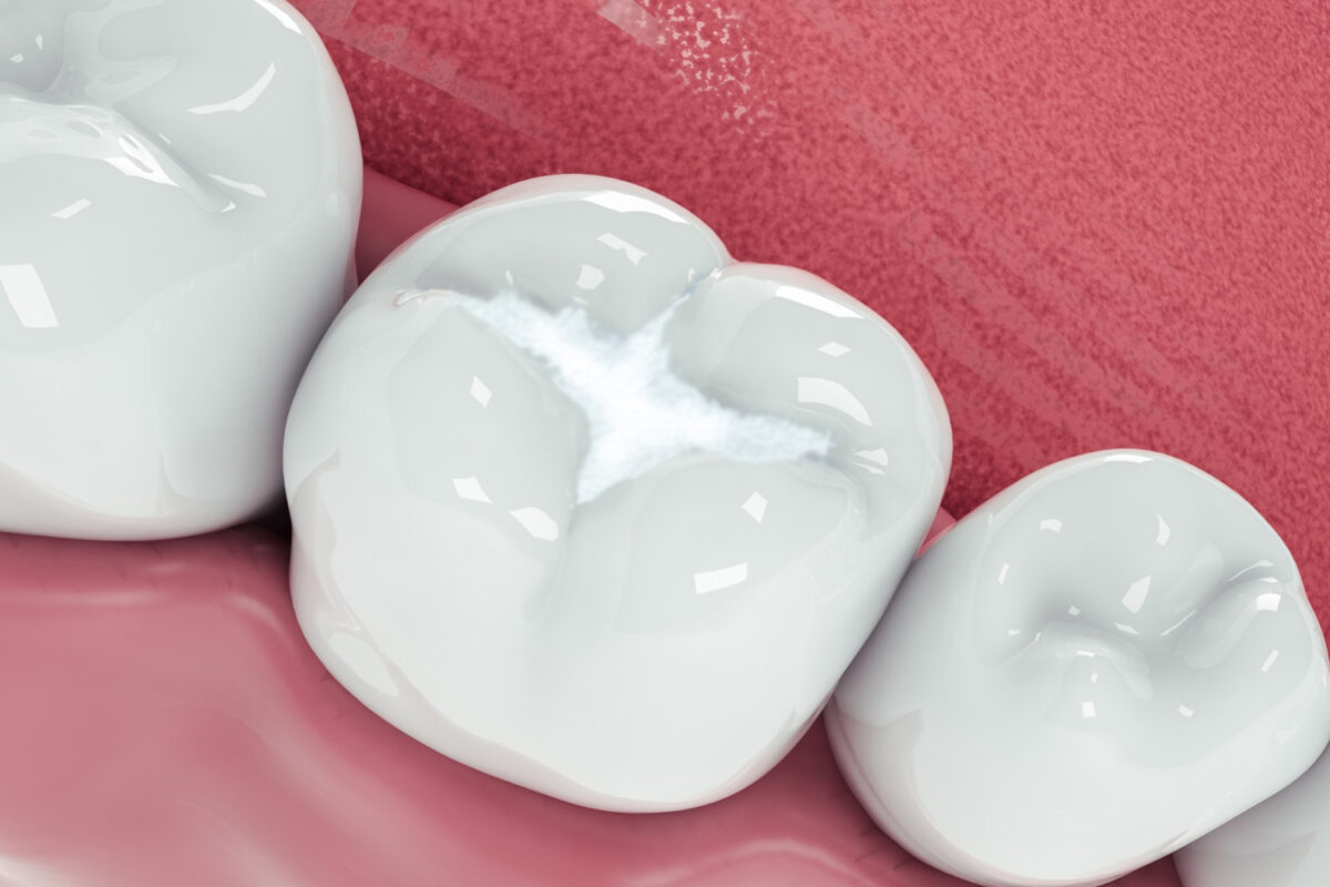 Fissure Sealants: A Proactive Approach to Dental Care