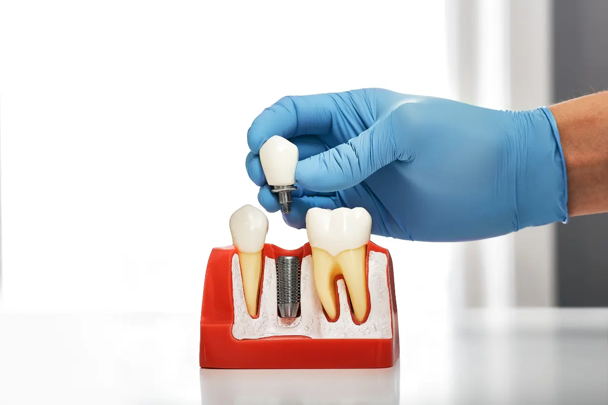 Most Affordable Dental Implants Without Sacrificing Quality