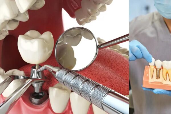Dental Implants Southlake TX: Cost, Procedure & Best Dentists