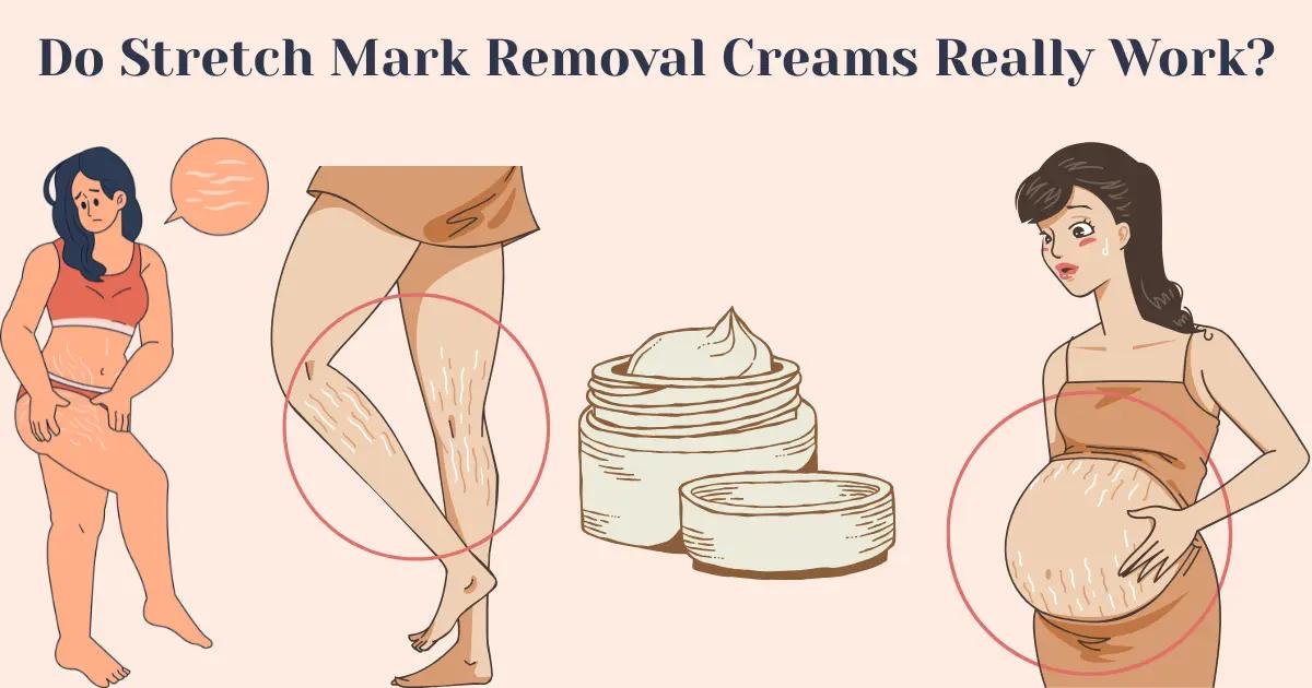 Do Stretch Mark Removal Creams Work? Science-Backed Guide